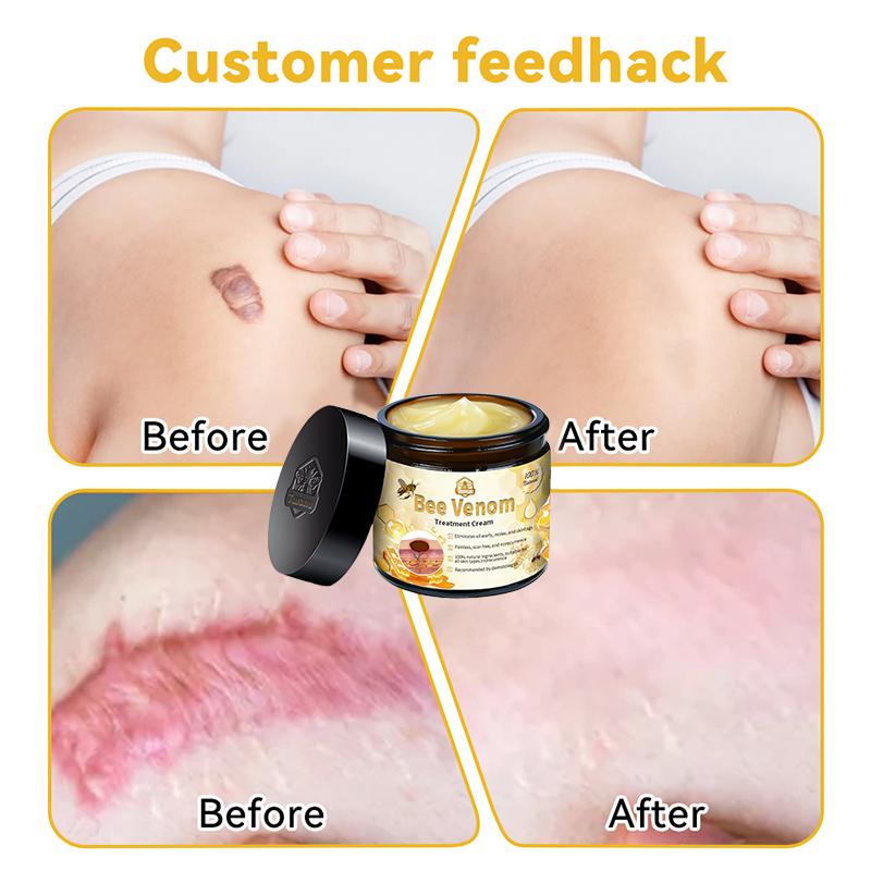 𝑇𝑢𝑟𝑜𝑛𝑢™ Bee Venom Skin Treatment Cream🏆🔥（𝐴𝐴𝐷 𝑅𝑒𝑐𝑜𝑚𝑚𝑒𝑛𝑑𝑒𝑑） (🔥𝑳𝒂𝒔𝒕 𝒅𝒂𝒚 𝒑𝒓𝒐𝒎𝒐𝒕𝒊𝒐𝒏 80% 𝒐𝒇𝒇)